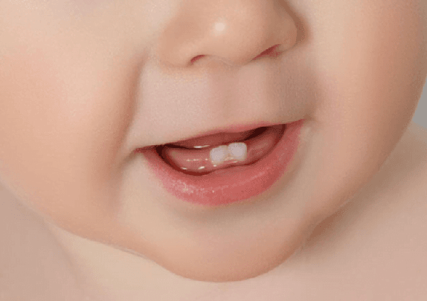 Bebeklerde Diş Çıkarmada Gecikme