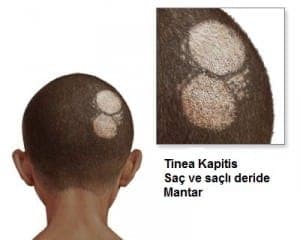 Tinea Kapitis (Saç Kıran)