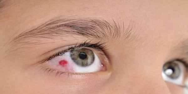 Alerjik Göz Hastalıkları (Konjunktivit)