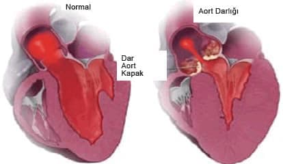 Aort Koarktasyonu (Aort Darlığı)