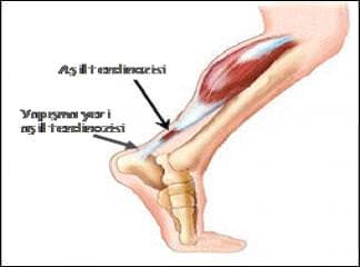 Aşil Tendonu (Aşil kirişi) Yırtıkları