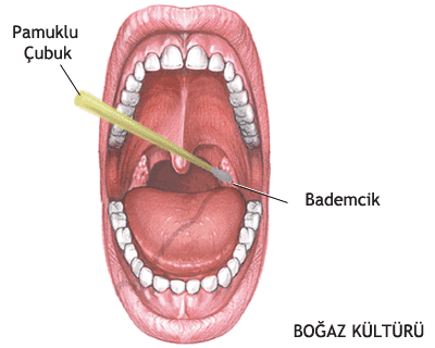 Bademcik İltihabı Belirtileri
