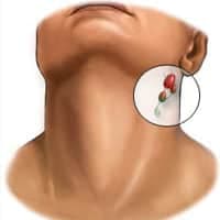 Lenf Bezi Büyümesi Nedir?