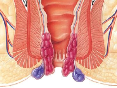 Hemoroid (Basur) Nedir?
