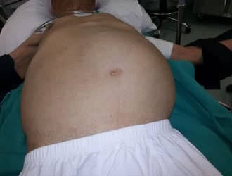 Kist Hidatik Hastalığının Ameliyatı