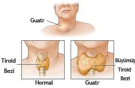 Guatr Hastalığı Tedavi ve Ameliyatı