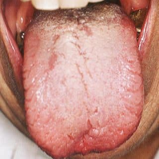 Dil Kanseri Ameliyatı