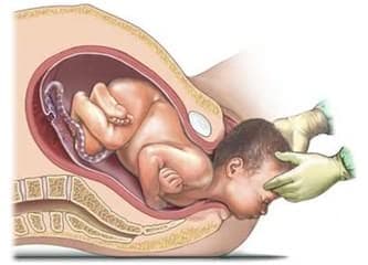 Normal Doğum Nedir?