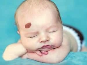 Doğum Lekeleri Nasıl Gider?