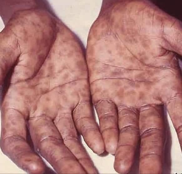 Frengi Hastalığı Nedir?