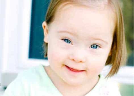 Down Sendromu Nedir?