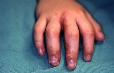 El Anomalileri Tedavisi