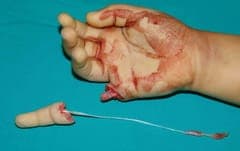 El Yaralanmaları Yapılması Gerekenler