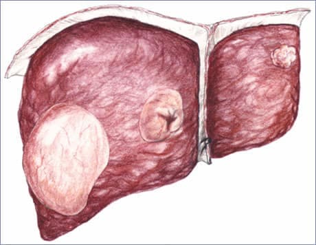 Karaciğer Kanserleri