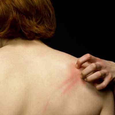 Kaşıntı Nedir, Kaşıntılı Hastalıklar