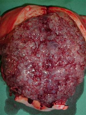 Mol Hidatidiform Hastalığı