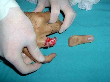 Replantasyon Cerrahisi