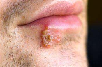 Uçuk (Herpes Simpleks)