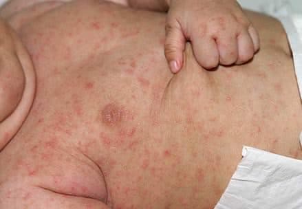 Uyuz (Scabies)