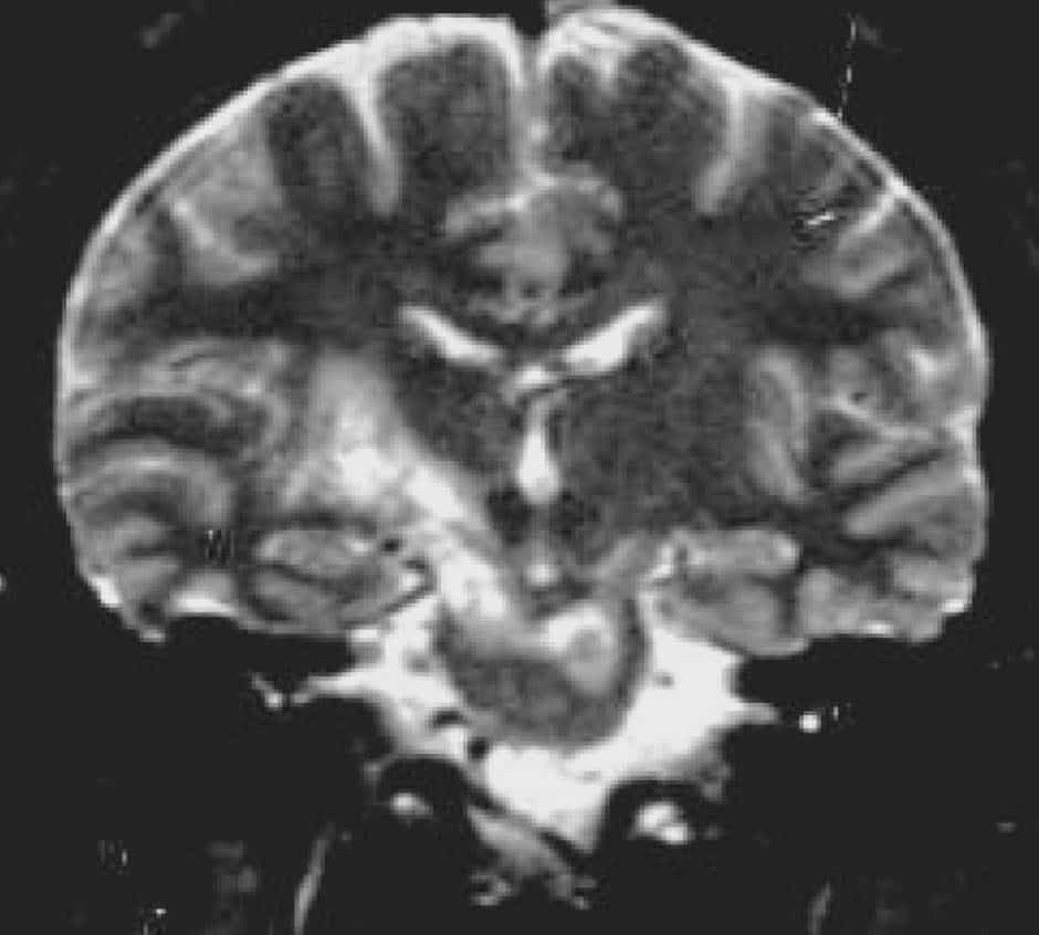 Vaskülit (Merkezi Sinir Sistemi)