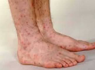 Vaskülit (Lökositoklastik)