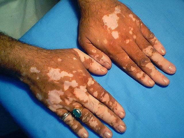 Vitiligo Tedavisi
