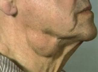 Lenfadenopatiler Hastalığı