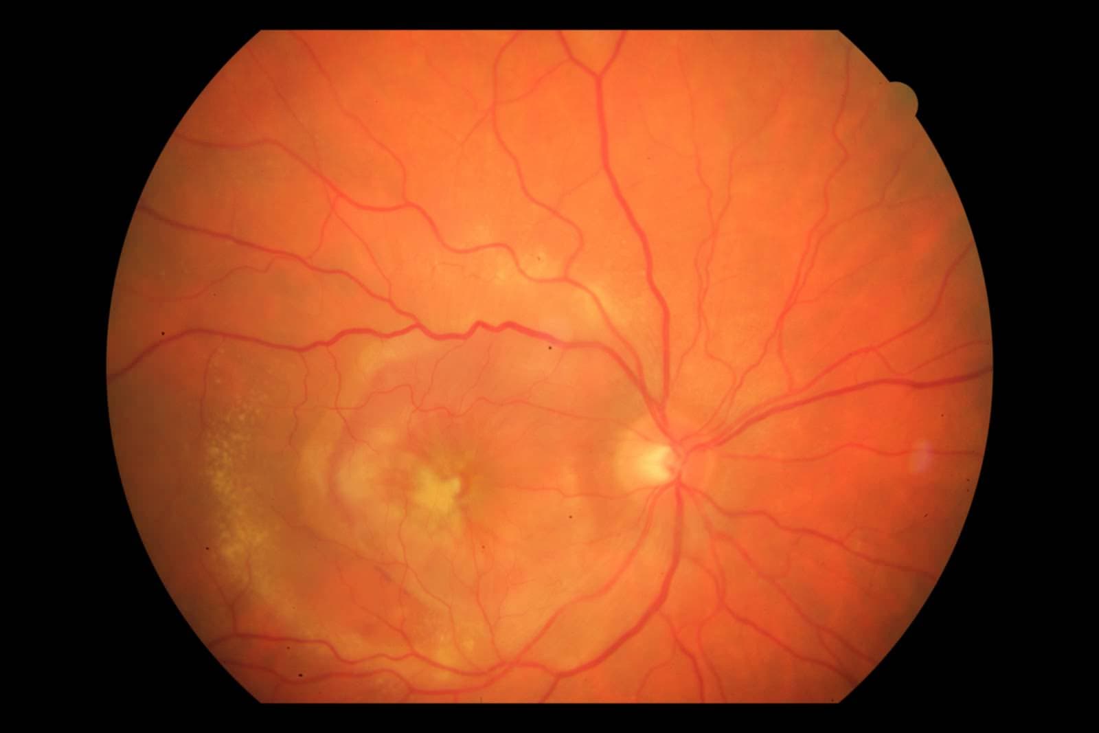 Makula Dejenerasyou Tedavisi