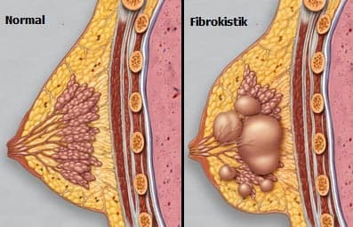 Memenin Fibrokistik Değişiklikleri