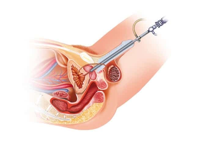 Mesane Taşı Tedavisi