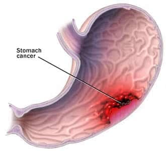 Mide Kanseri Nedenleri?
