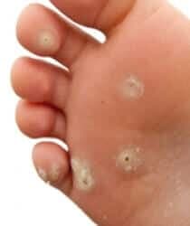 Siğiller Bitkisel Tedavi