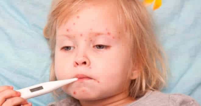 Su Çiçeği Belirtileri