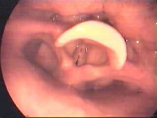 Ses Telinde Granülom