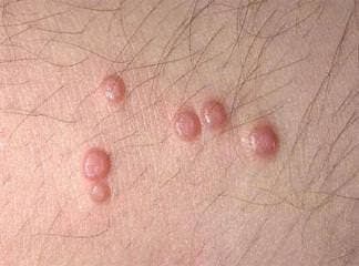 Molluskum Kontagiozum