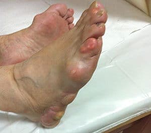 Psödogut (Yalancı Gut) Hastalığı