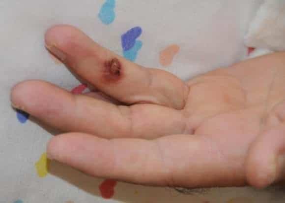 Şarbon Hastalığı Nedir?